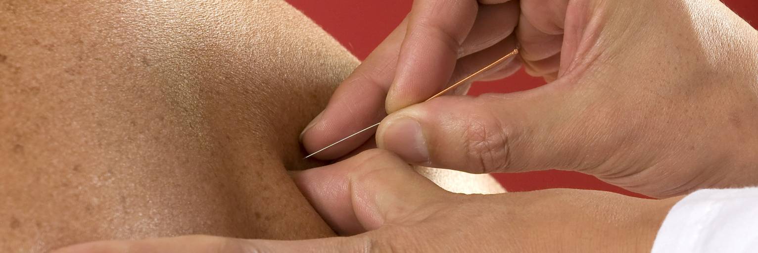 Akupunktur